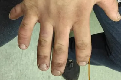 Необычное явление природы: 6 пальцев на руке