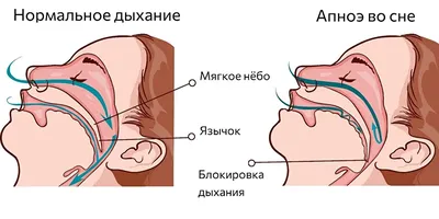 Антихрап повязка от храпа на голову средство приспособление для сна  универсальное для лечение храпа и апноэ (ID#1119357035), цена: 625 ₴,  купить на Prom.ua