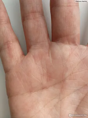 Абсцесс на руке: качественное изображение