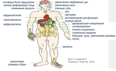 Акромегалия клиническая картина - 93 фото