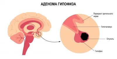 Наступает социальная изоляция»: как живут люди с акромегалией в России — РТ  на русском