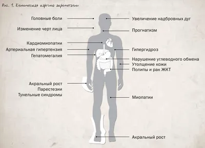 Открытые-НКО - «Меня стали сравнивать с Фионой»: истории людей с редким  заболеванием – акромегалией, которым помогает фонд «Великан» [видео]