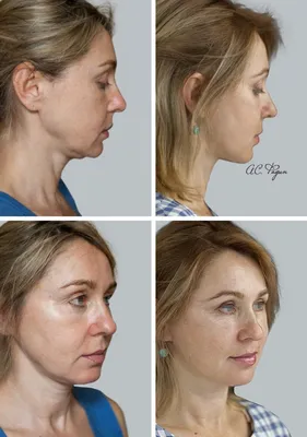 Виктория Боня впервые показала лицо спустя 2,5 месяца после операции