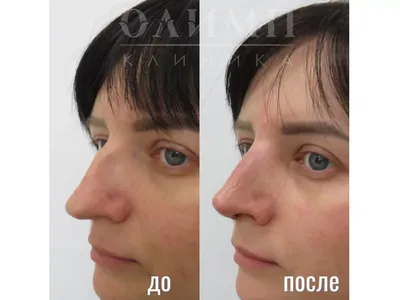 Ухо на 3D-принтере: в США впервые напечатали ухо и пересадили его женщине |  СП - Новости Бельцы Молдова