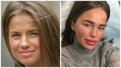 Как изменились лица российских и зарубежных звёзд до и после пластических  операций