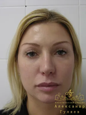 Саша Черно показала первые фото после операции по удалению второго  подбородка - Вокруг ТВ.