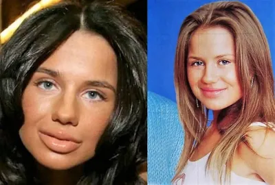 Фото до и после пластики носа у Украинского Алексея Ивановича