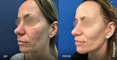 Фото до и после пластики лица | Личный сайт пластического хирурга А. Жукова