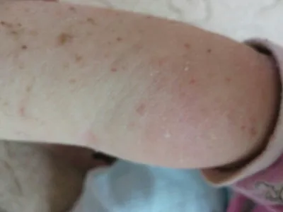Фотография рук с аллергической экземой для научных исследований