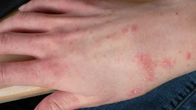 Изображение аллергической сыпи на руках с глубокими тонами