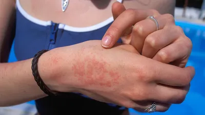 Фотография аллергической сыпи на руках в формате JPG