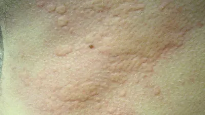 Фотография аллергической сыпи на руках в высоком разрешении