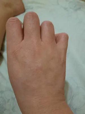 Аллергическая сыпь на руках: фото с близкими деталями
