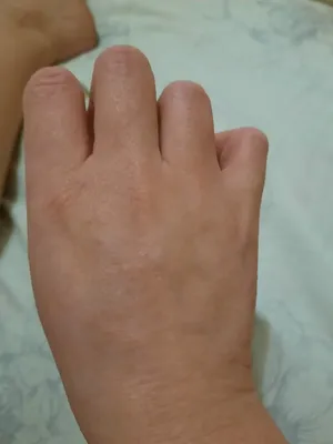 Изображение аллергической сыпи на руках в формате PNG