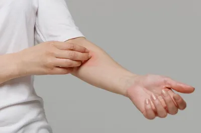 Фотография аллергической сыпи на руках: средний план