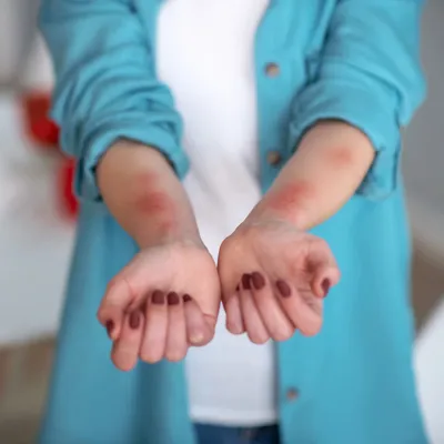 Фотография аллергической сыпи на руках с макрофотографией