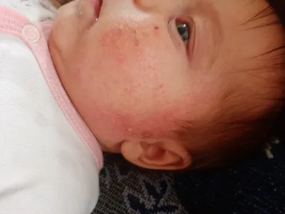 Аллергическая сыпь на руках у ребенка: как ее отличить от других высыпаний