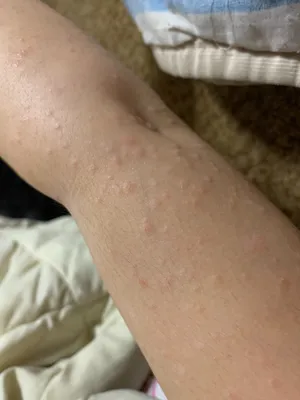 Изображения аллергической сыпи на руках при аллергии на пыльцу