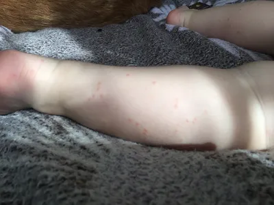 Изображения аллергической сыпи на руках малыша