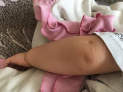 Фото аллергической реакции на руках у ребенка