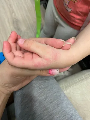 Аллергическая сыпь на руках у грудного ребенка: фото и лечение