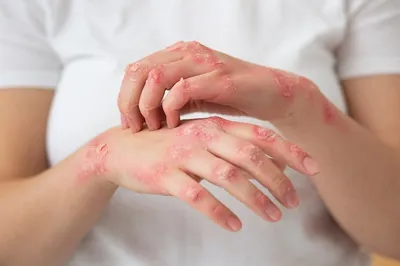 Изображения аллергических пятен на руках для диагностики