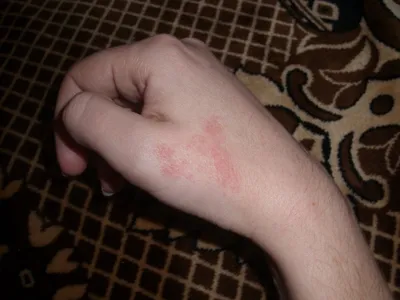Аллергические пятна на руках в высоком качестве (JPG, PNG, WebP)