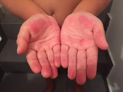Картинка рук с аллергическими пятнами: симметричный кадр