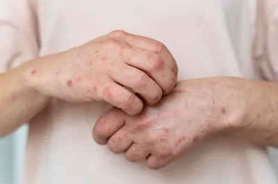 Фотография аллергических высыпаний на руках: естественное освещение