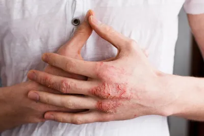 Аллергический дерматит на руках фотографии