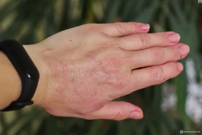 Фото аллергического дерматита на руках: для медицинских журналов