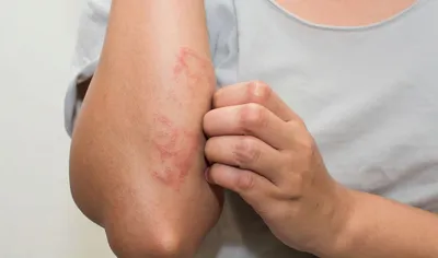 Фотографии аллергического дерматита на руках: эффективное лечение