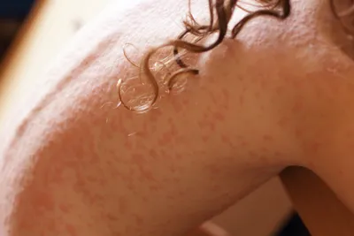 Картинка аллергического дерматита на руках в активной стадии
