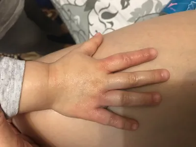 Фото аллергического дерматита на руках с народными средствами