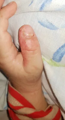 Фотография аллергического дерматита на руках после лечения