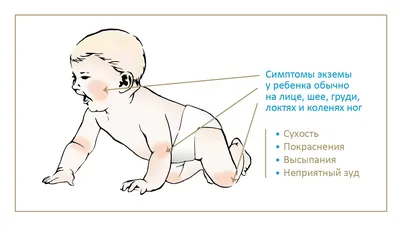 Простуда или аллергия? Как отличить