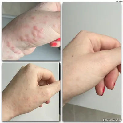 Сыпь на руках от химической аллергии: фото и причины возникновения