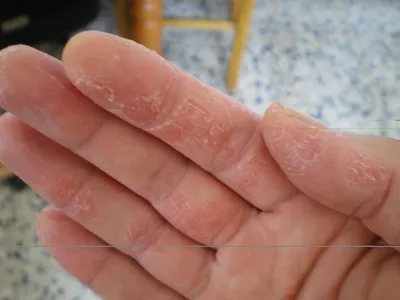 Как узнать о аллергии на жидкое мыло: фотографии и первые признаки