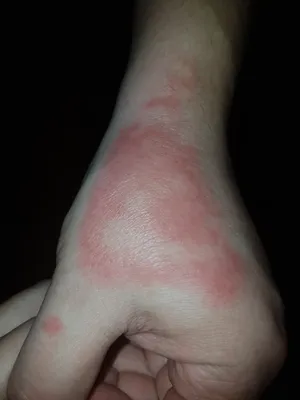 Фото: Аллергия на холод на руках на белом фоне