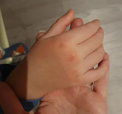 Фотка: Руки с красными пятнами от аллергии на холод в хорошем качестве