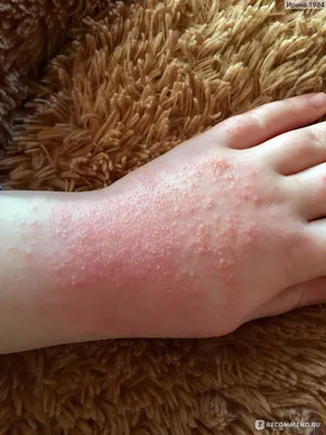 Фотография: Аллергия на холод на руках у подростка