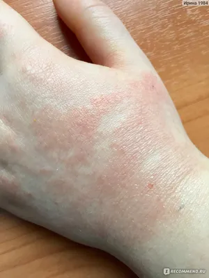Изображение: Аллергия на холод на руках у девушки в PNG
