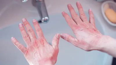 Фото: Руки с высыпаниями из-за аллергии на холод