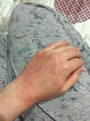 Фотография рук с симптомами аллергии на холод