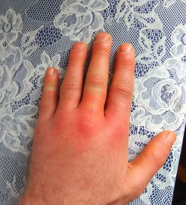 Фото рук с аллергией на холод: высокое качество
