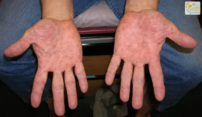 Изображения рук с аллергией на кистях