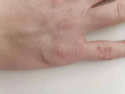 Картинки аллергии на кистях рук: какую диету следует соблюдать 