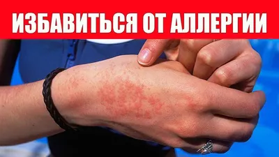 Аллергия на коже рук: крупное изображение в формате JPG