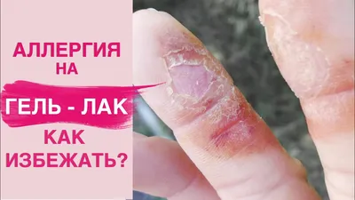 Аллергия на коже рук: фото с высокой четкостью