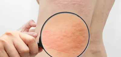Фото аллергии на коже рук: качественное изображение